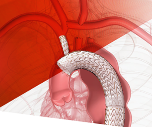 GORE&reg; TAG&reg; Thoracic Branch Endoprosthesis