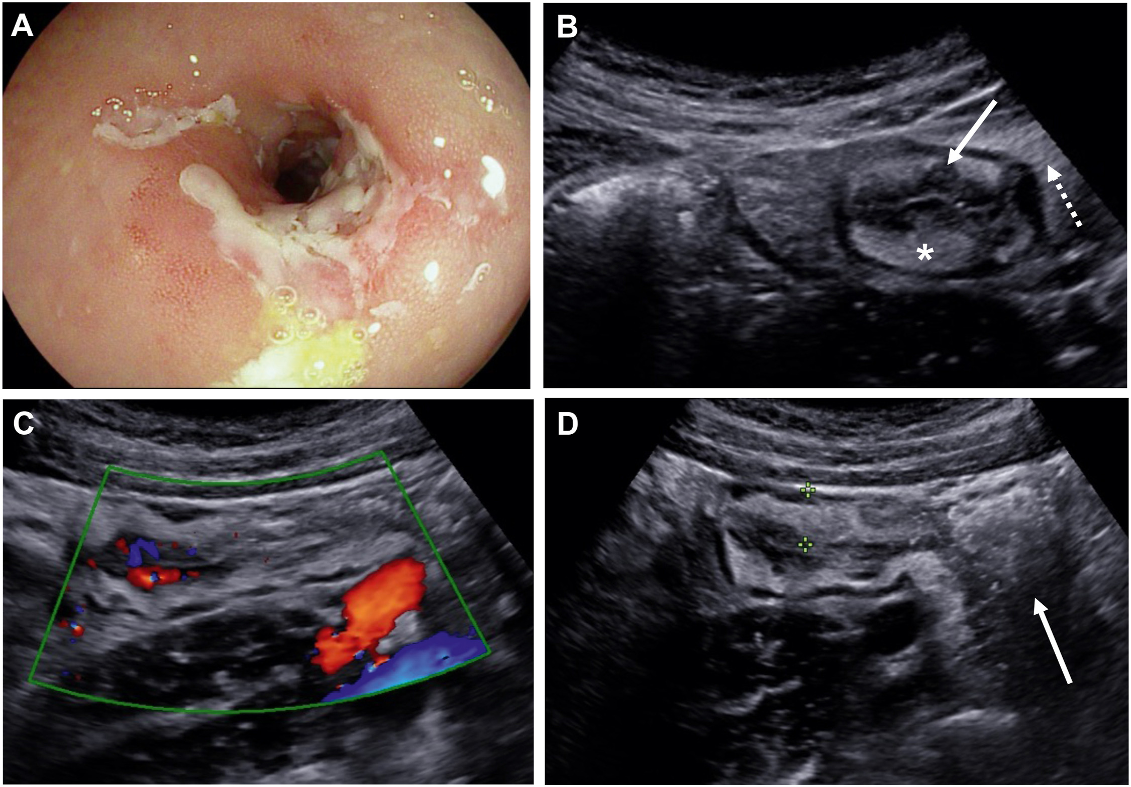 Management of Small Bowel Crohn’s Disease Strictures: To Cut, to Stretch, or to Treat Inflammation?